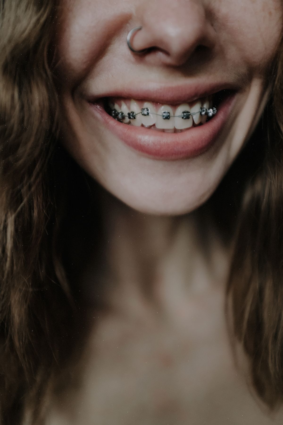 Primer plano de una sonrisa con brackets